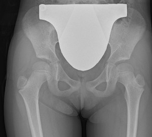 6歳女児 股関節炎が疑われ撮影された骨盤の単純X線撮影