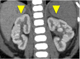 石灰化した腎臓（矢頭）の画像