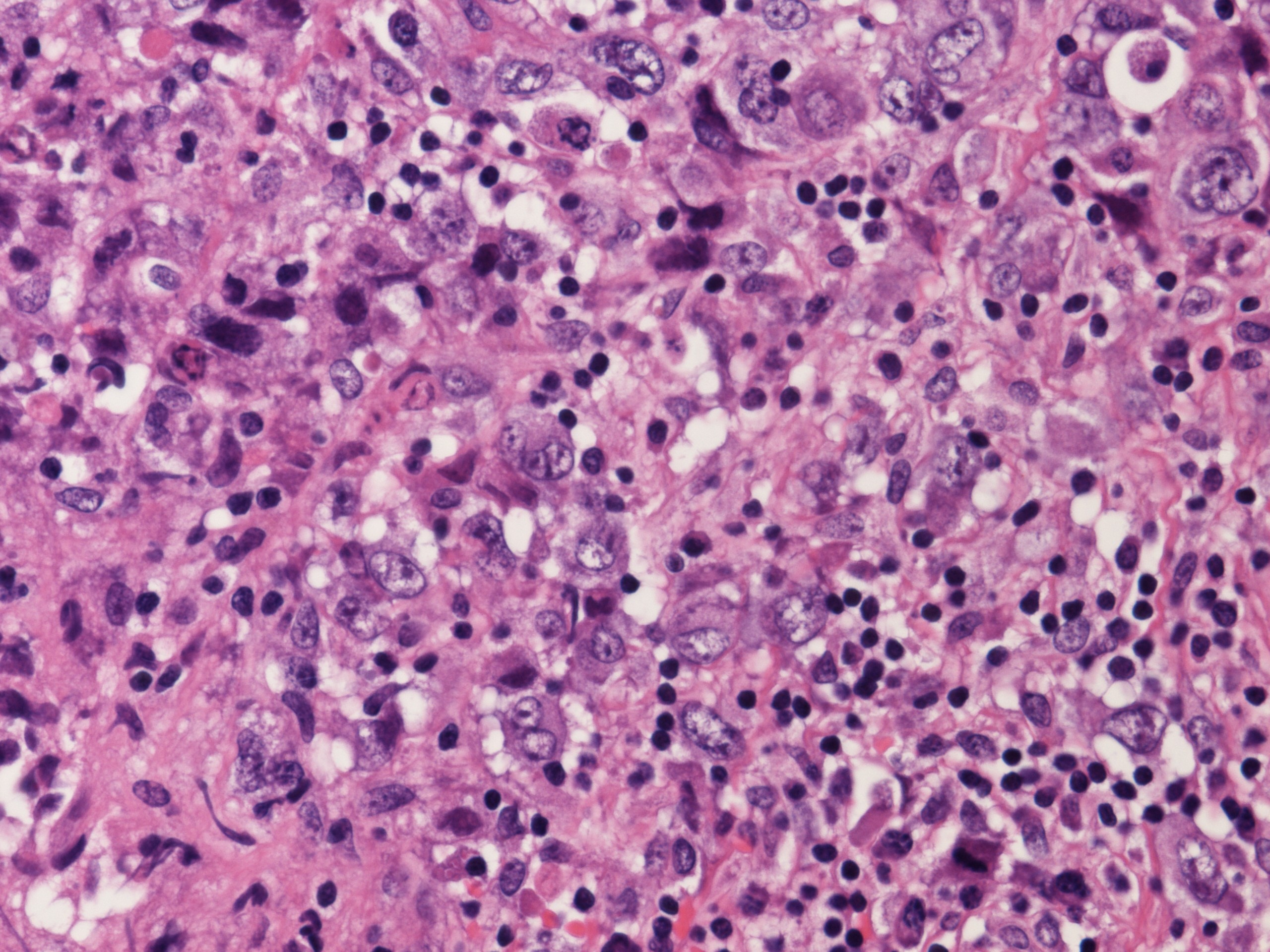 未分化大細胞性リンパ腫(Anaplastic Large Cell Lymphoma)の病理組織像
