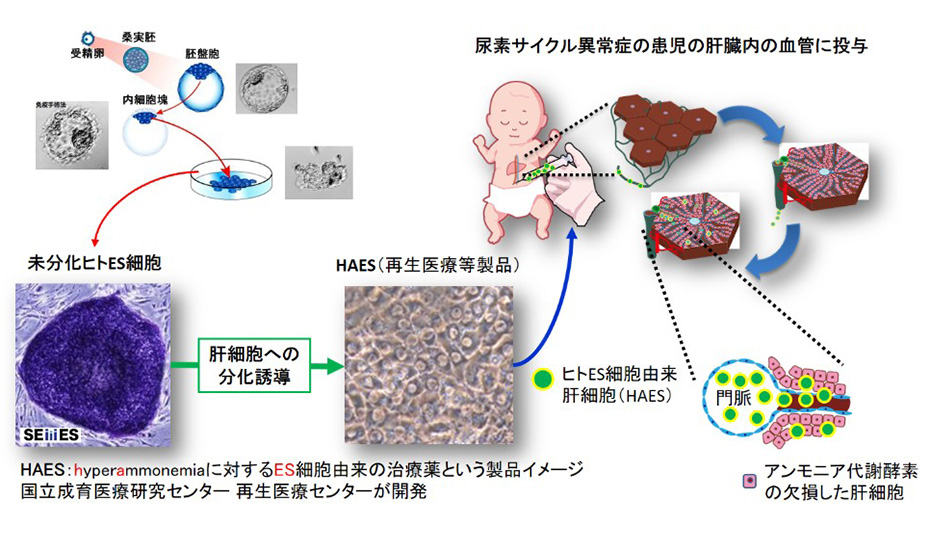 先天性尿素サイクル異常症に対するHAES移植治療の医師主導治験―新生児期発症型患者を対象とした探索的試験―