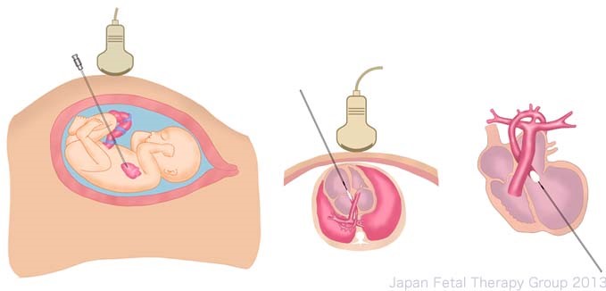 胎児治療の画像