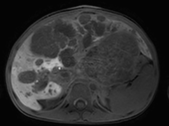図1　肝芽腫症例