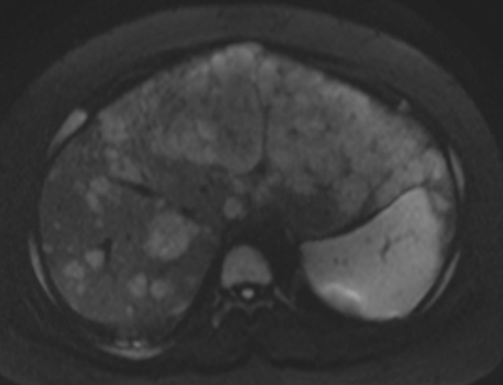 図3　拡散強調画像(Diffuion weighted image: DWI)