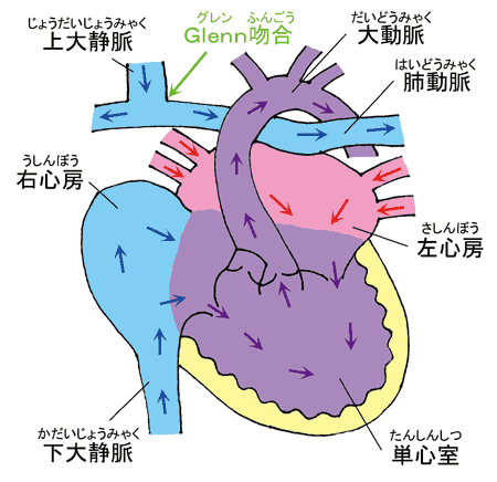 グレン手術の画像