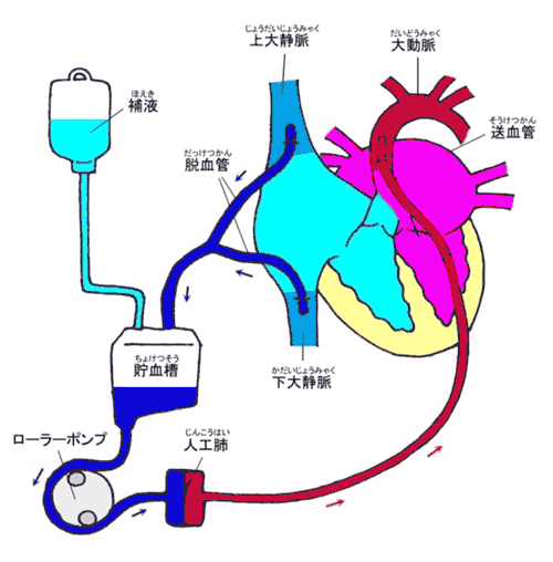 人工心肺の画像