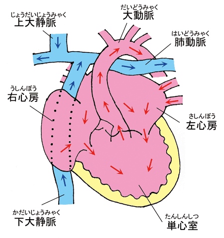 フォンタン手術の画像