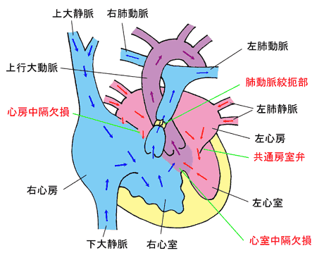 肺動脈絞扼術の画像