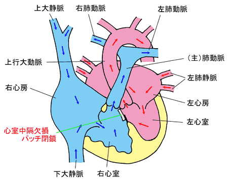 心室中隔欠損閉鎖術の画像