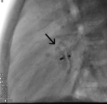 Amplatzer閉塞栓(→)による心房中隔欠損閉鎖術。の画像