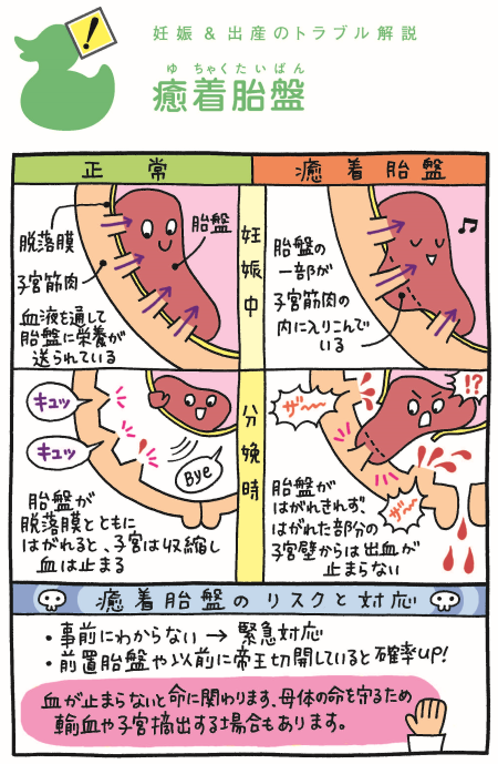 早期流産の手術の漫画