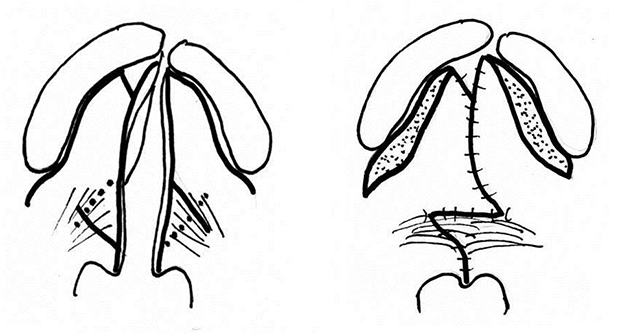 Furlow変法のイラスト図