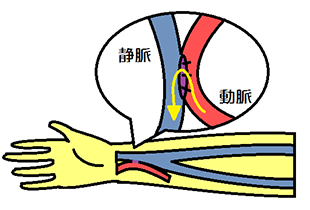 血液透析の説明図2