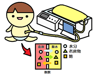 腹膜透析の説明図