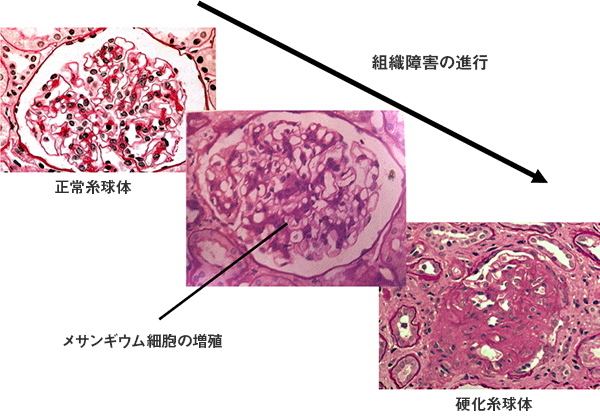糸球体の組織障害の進行図：正常糸球体→メサンギウム細胞の増殖→硬化糸球体