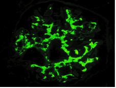 メサンギウム領域へのIgA沈着の画像
