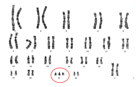 ダウン症候群の染色体の図