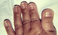 幅広な母指の手の写真
