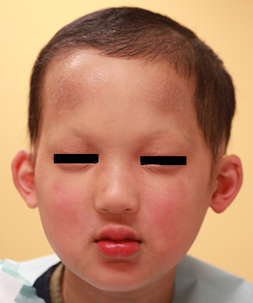 外胚葉異形成症のこどもの顔の写真