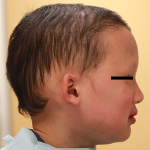 外胚葉異形成症のこどもの横顔の写真