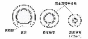 正常、軽度狭窄、高度狭窄(<2mm)の気管の図