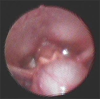 喉頭のう胞の画像