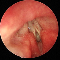 先天性声門下狭窄の喉頭の画像