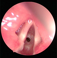 後天性声門下狭窄の喉頭の画像