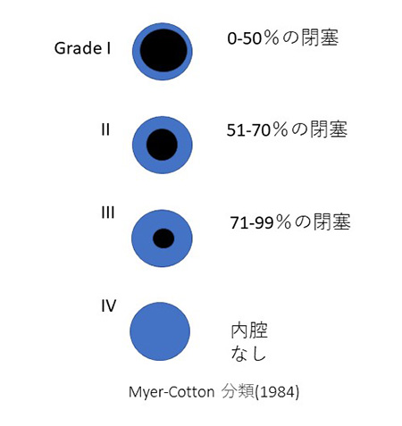 GradeI:0-50%程度の閉塞、GradeⅡ:51-70%程度の閉塞、GradeⅢ:71-99%程度の閉塞、GradeⅣ:内腔なし、Myer-Cotton分類（1984）
