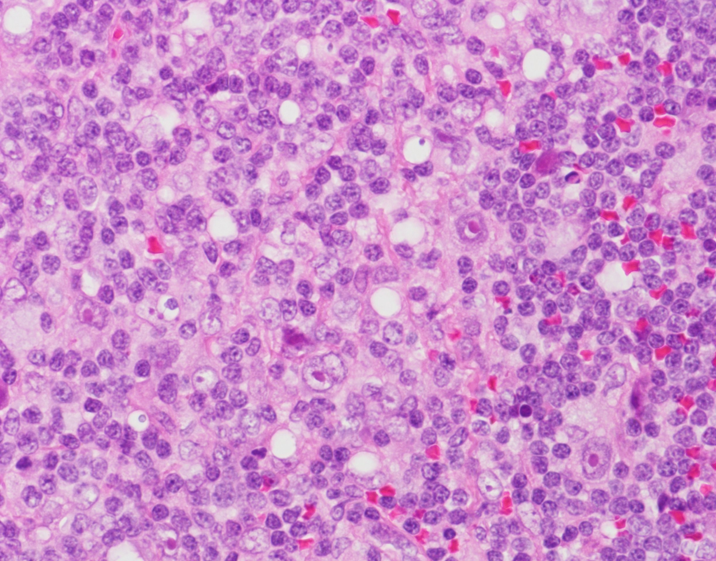 びまん 性 大 細胞 型 b 細胞 リンパ腫
