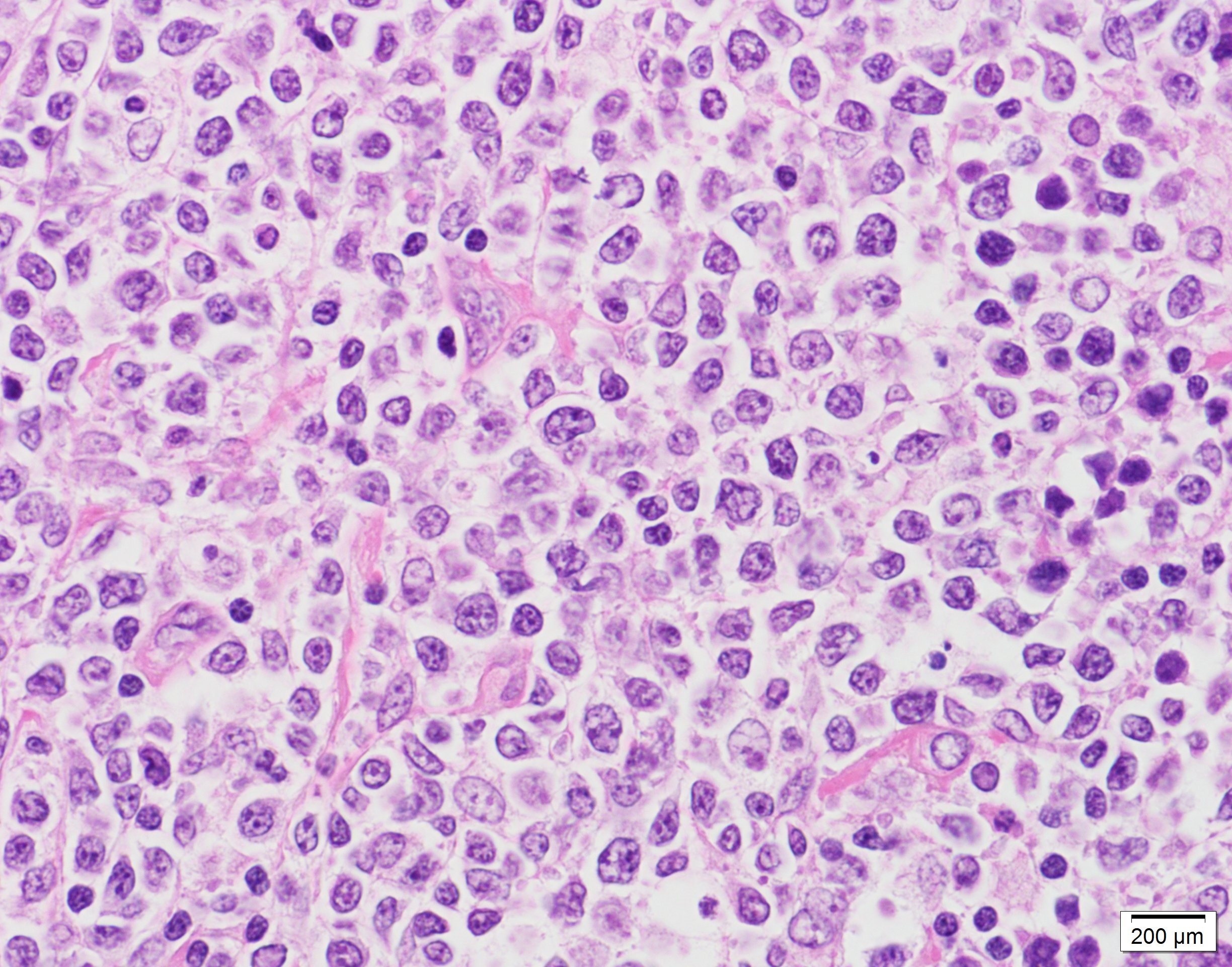 びまん 性 大 細胞 型 b 細胞 リンパ腫
