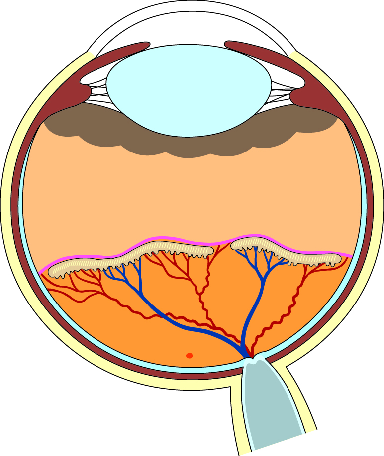血管増殖の発芽のイラスト図