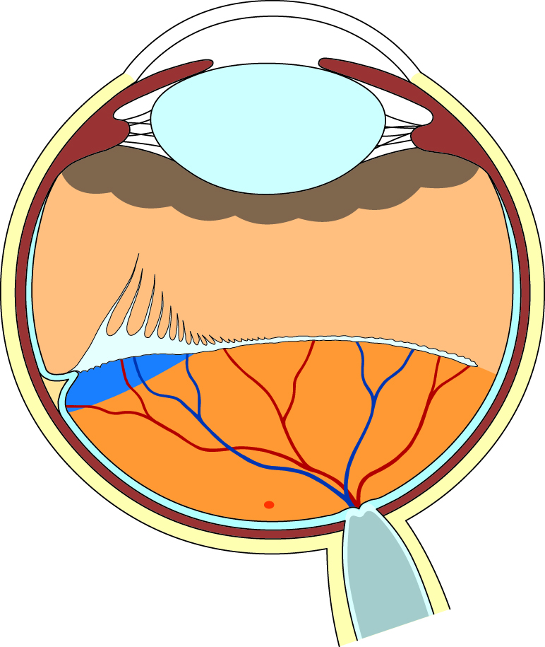 増殖進行と網膜剥離の始まりのイラスト図
