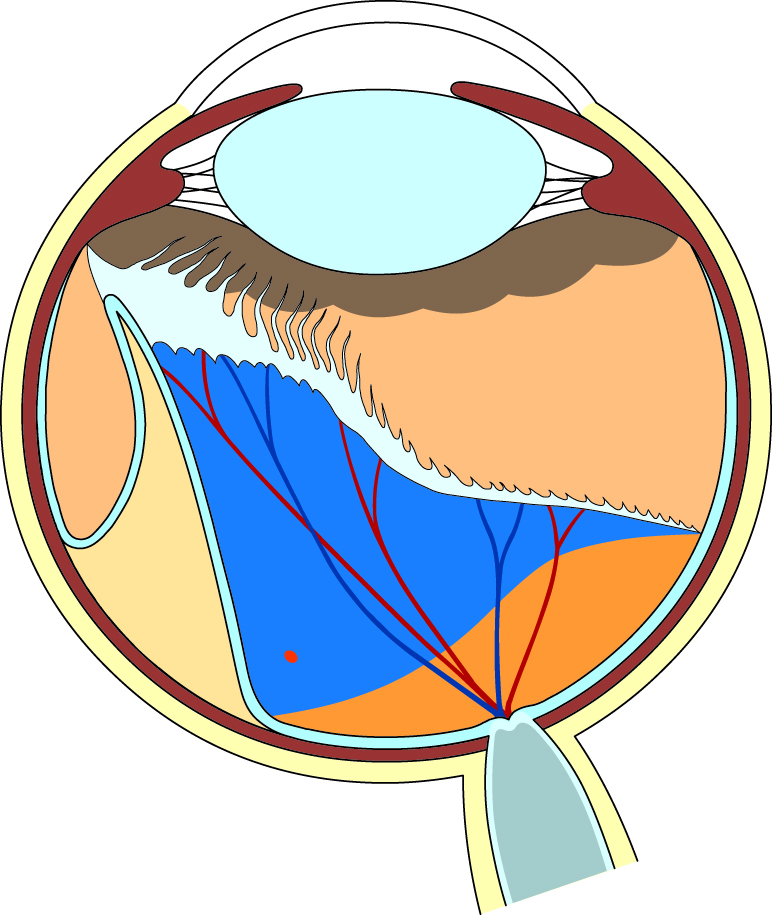 高度な網膜剥離のイラスト図