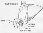 小児生体肝移植の再建図の画像