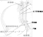 成人生体肝移植の再建図の画像