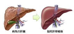 脳死肝移植の画像