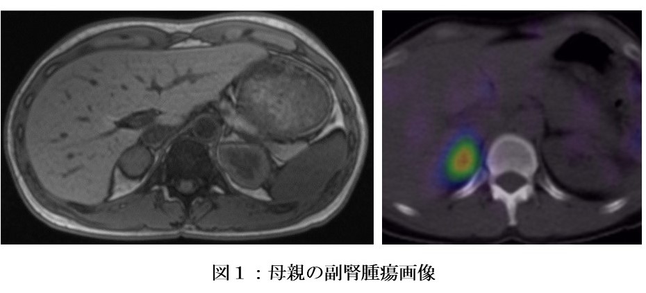 図1：母親の副腎腫瘍画像