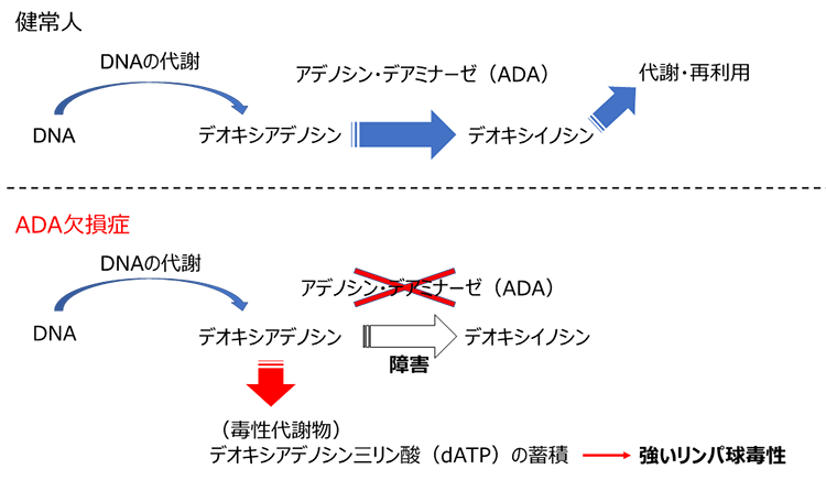 健常人とADA欠損症の人の違い