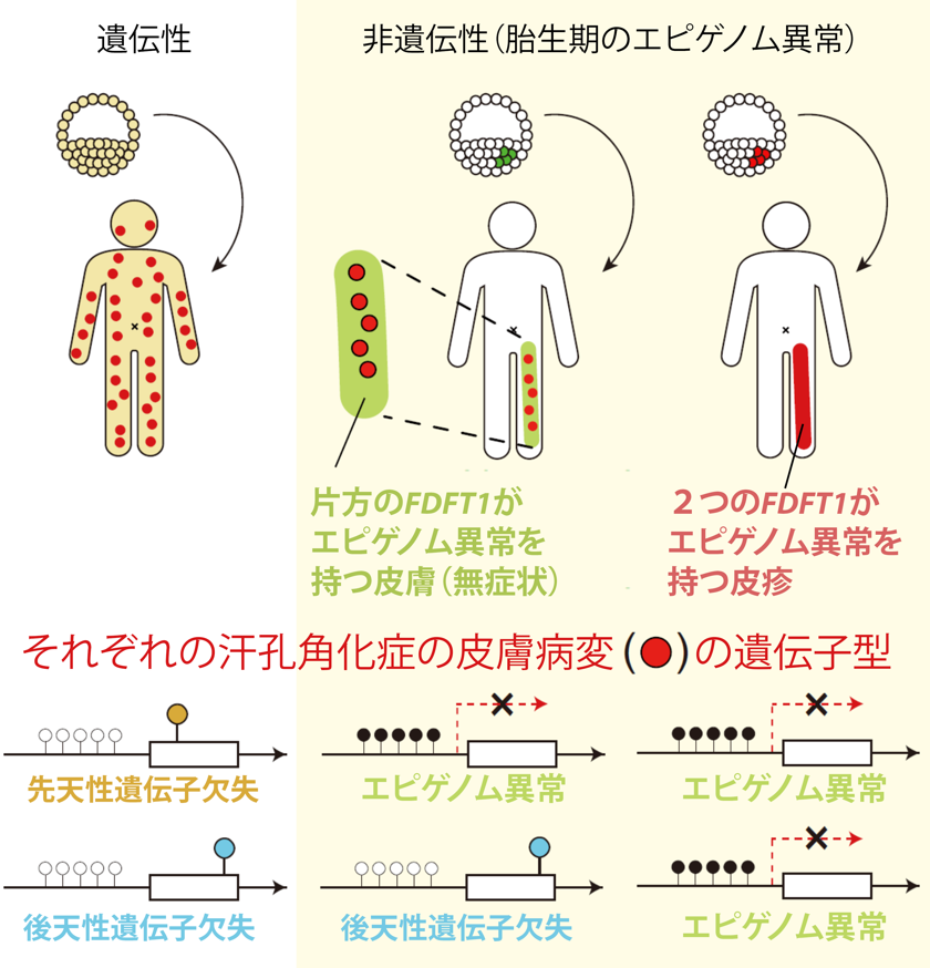 図１：汗孔角化症の皮膚病変ができるしくみ