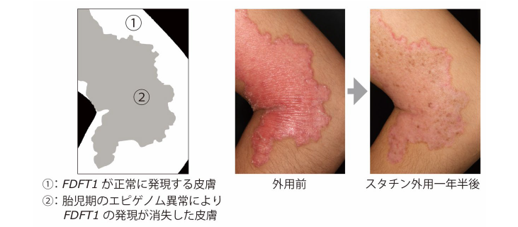 図2:胎生期に生じたエピゲノム異常によりFDFT1の発現が消失した皮膚に、強い炎症と過角化をともなう汗孔角化症の病変が形成されていた。スタチン外用治療により皮疹は軽快した。