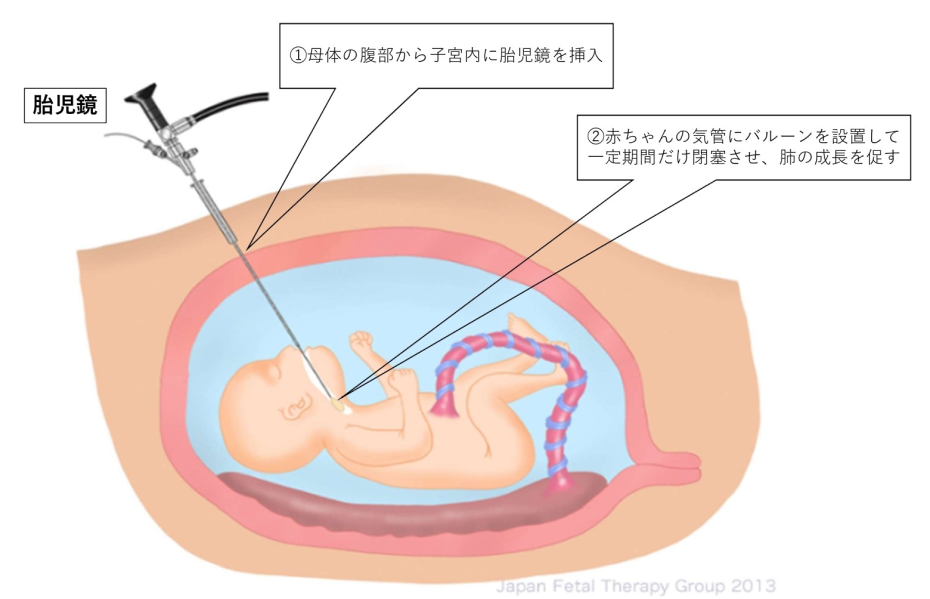 日本における先天性横隔膜ヘルニアの胎児治療成績を発表 生存率および生存に関わる肺面積のカットオフ値が明らかに
